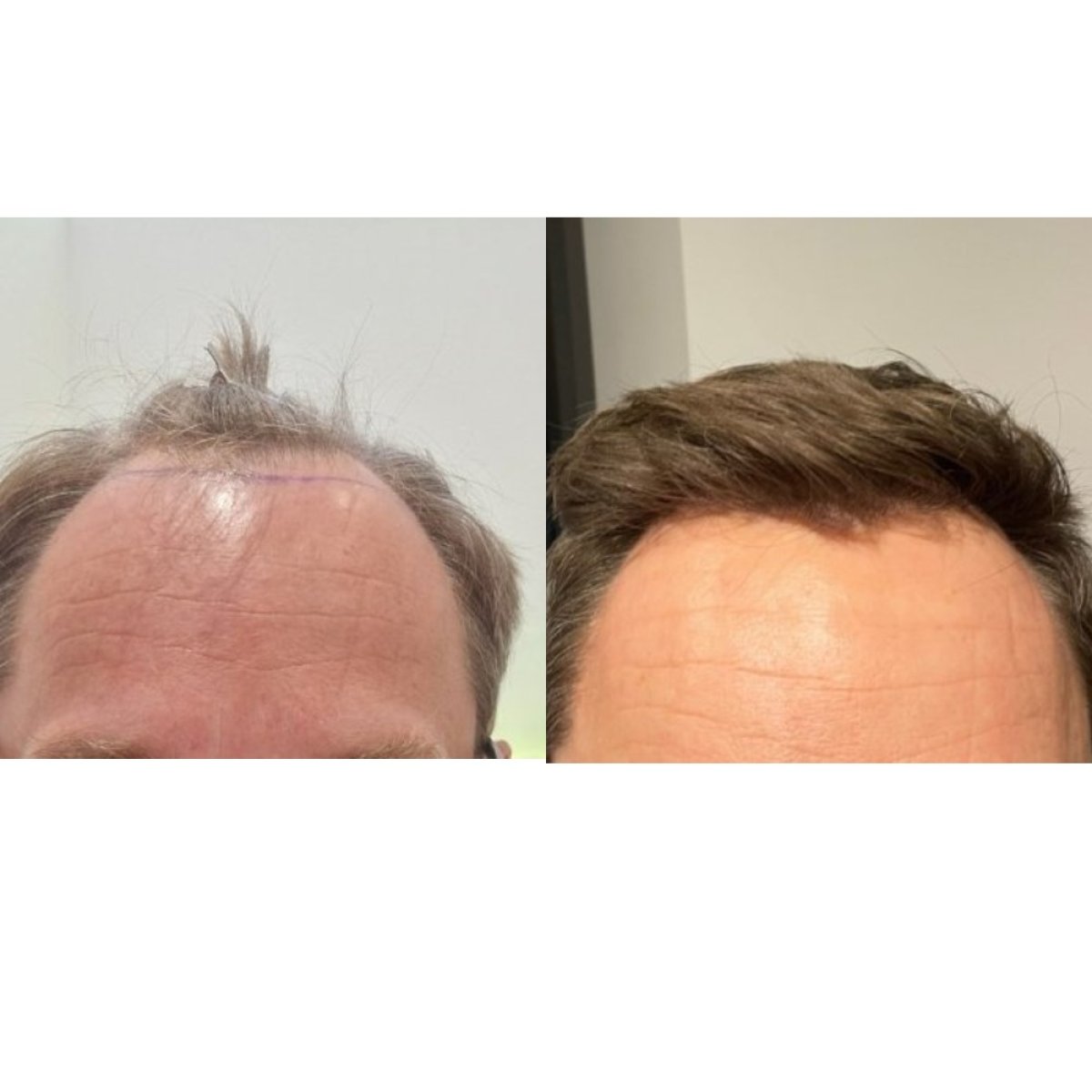 Resultado antes y después de trasplante capilar FUE en Hair Clinic PRIVÉ, línea restaurada