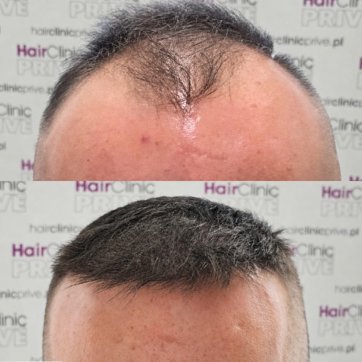 Résultat avant/après greffe de cheveux FUE à Hair Clinic PRIVÉ, ligne capillaire restaurée