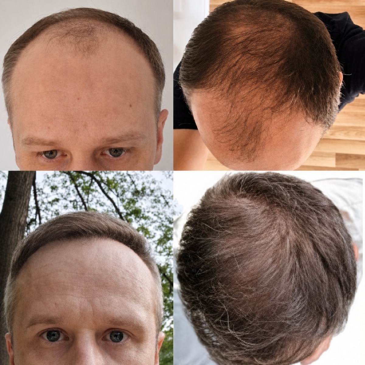 نتائج قبل وبعد زراعة الشعر FUE في Hair Clinic PRIVÉ، كثافة شعر مستعادة