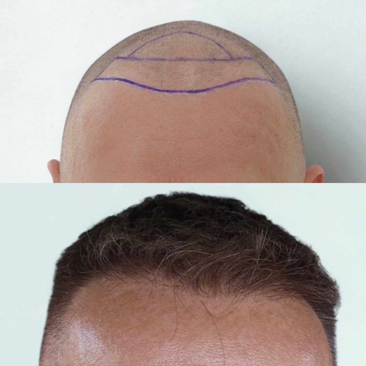 Before and after FUE hair transplant result at Hair Clinic PRIVÉ showing restored hairline