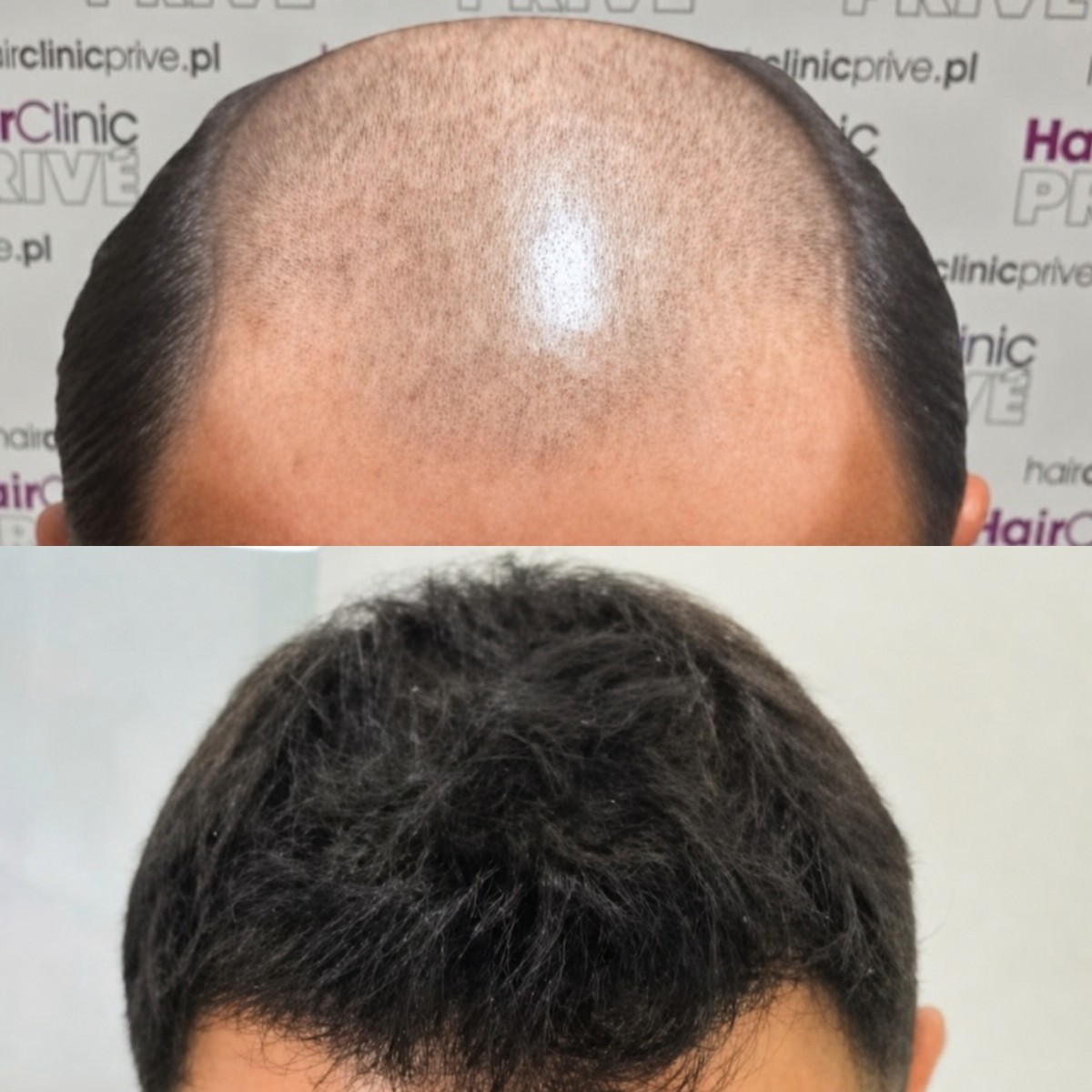 Vorher-nachher-Ergebnis FUE-Haartransplantation bei Hair Clinic PRIVÉ, Haaransatz wiederhergestellt