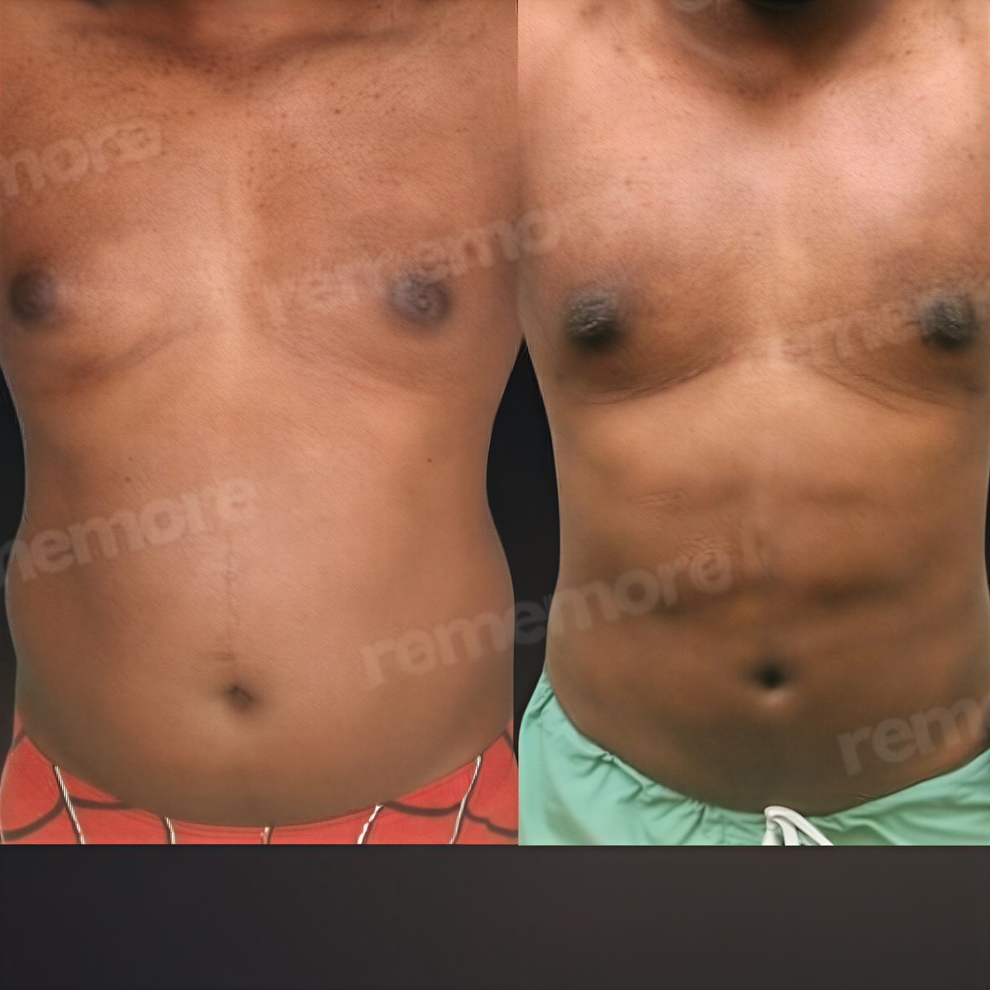 Resultados de abdominoplastia y liposucción antes y después en Memorial Göztepe Hospital, abdomen plano