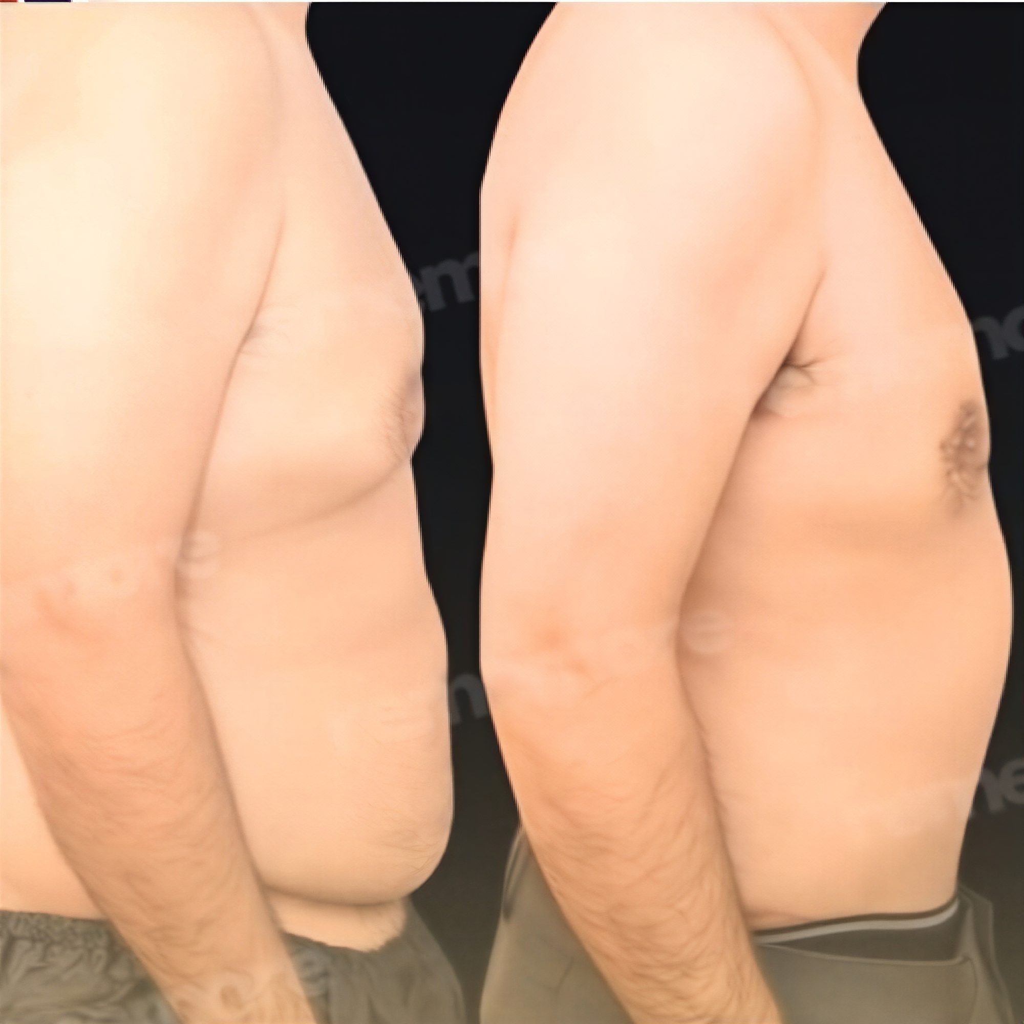Resultados antes y después de abdominoplastia y liposucción en Memorial Göztepe Hospital