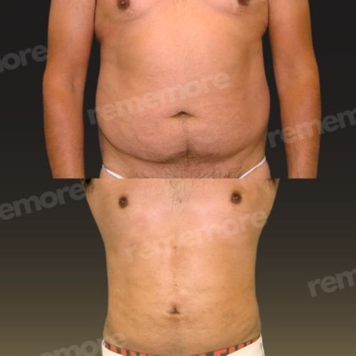 Before and after tummy tuck and liposuction results at Memorial Göztepe Hospital, flatter abdomen