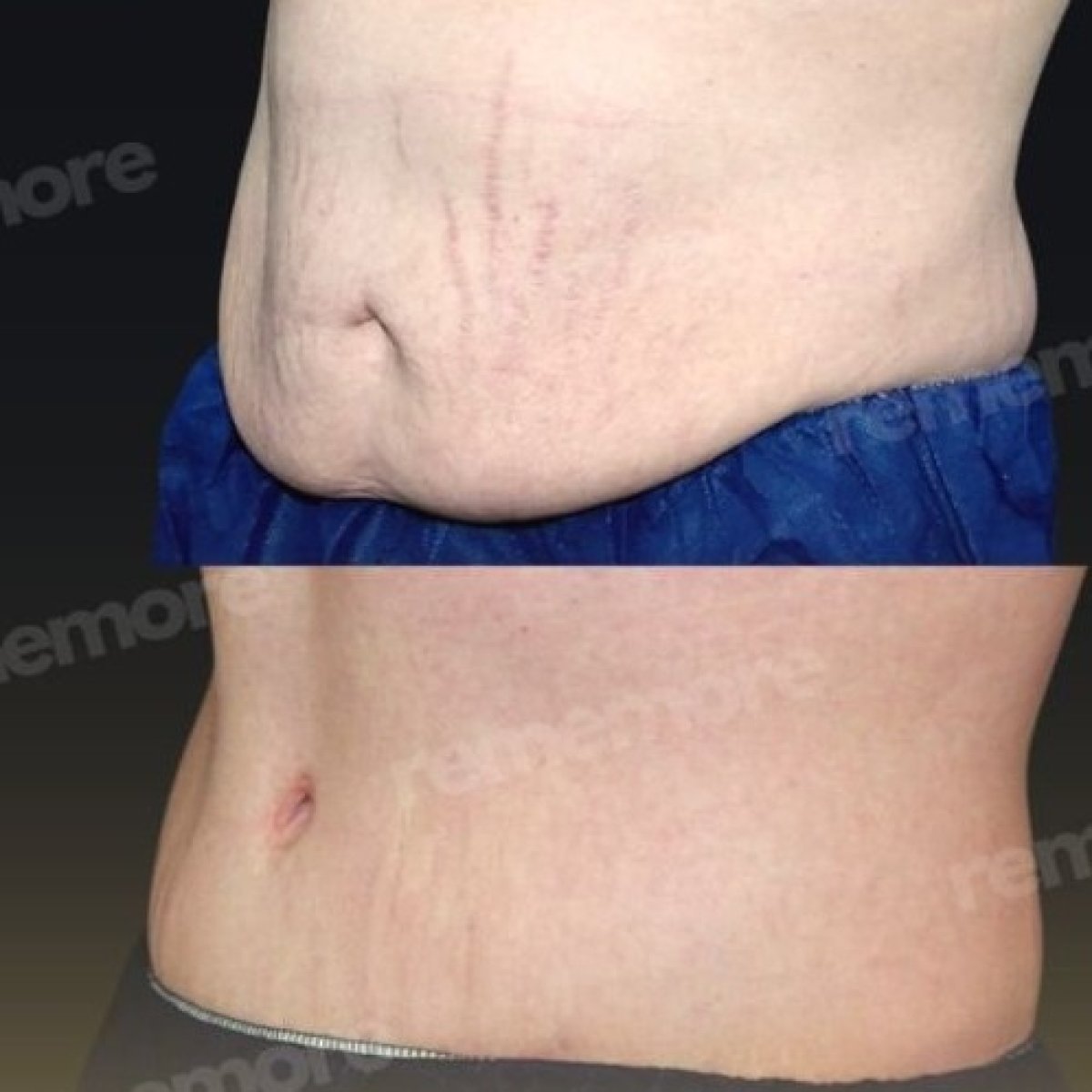 Before and after tummy tuck and liposuction results at Memorial Göztepe Hospital, flatter abdomen