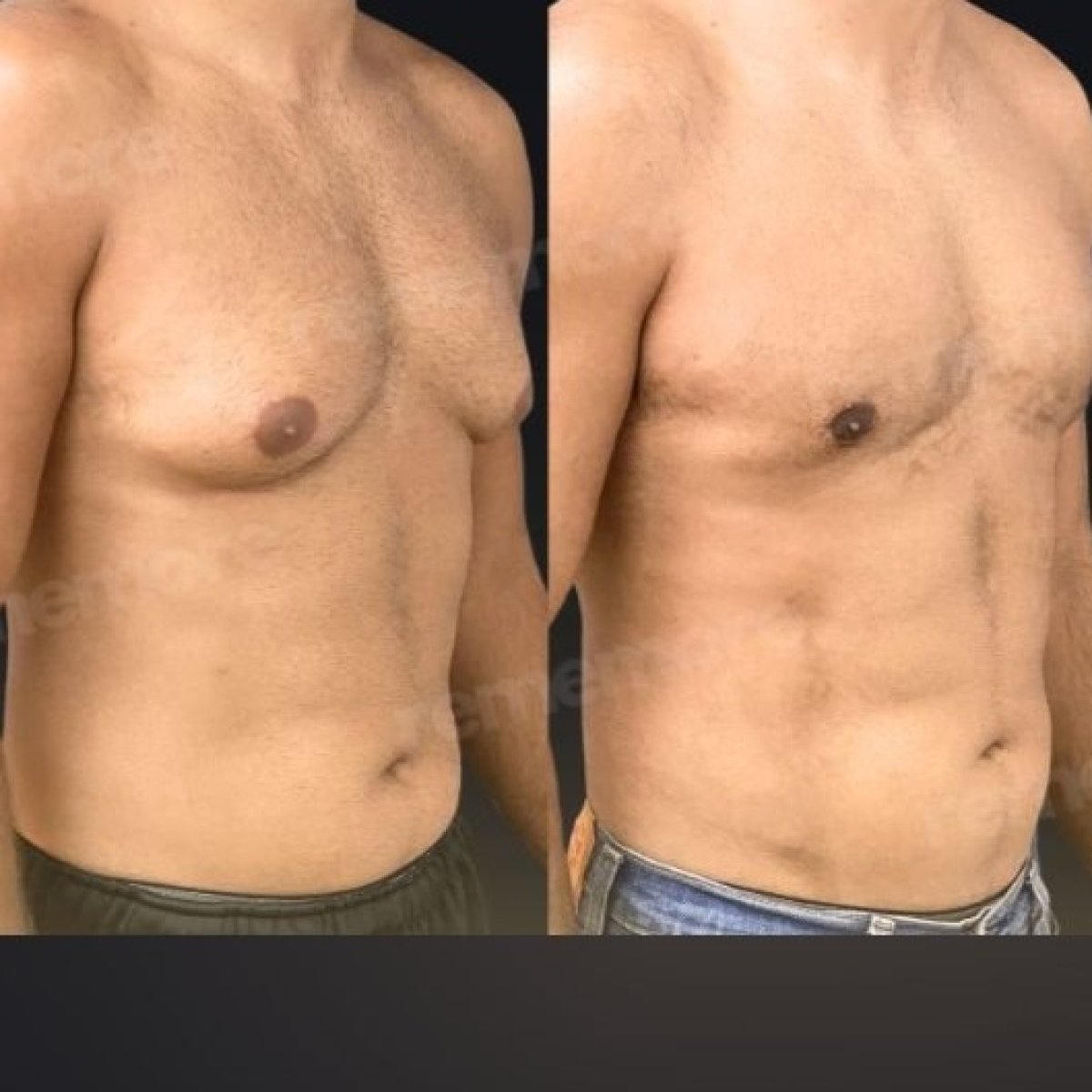 Before and after tummy tuck and liposuction results at Memorial Göztepe Hospital for men