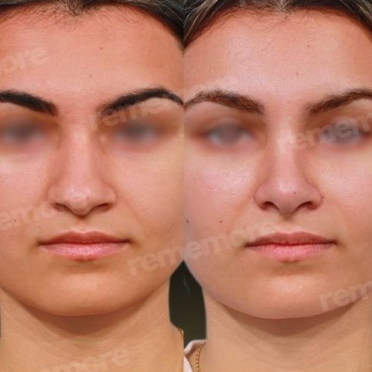 Resultados antes y después de rinoplastia étnica en Memorial Bahçelievler Hospital, remodelación nasal