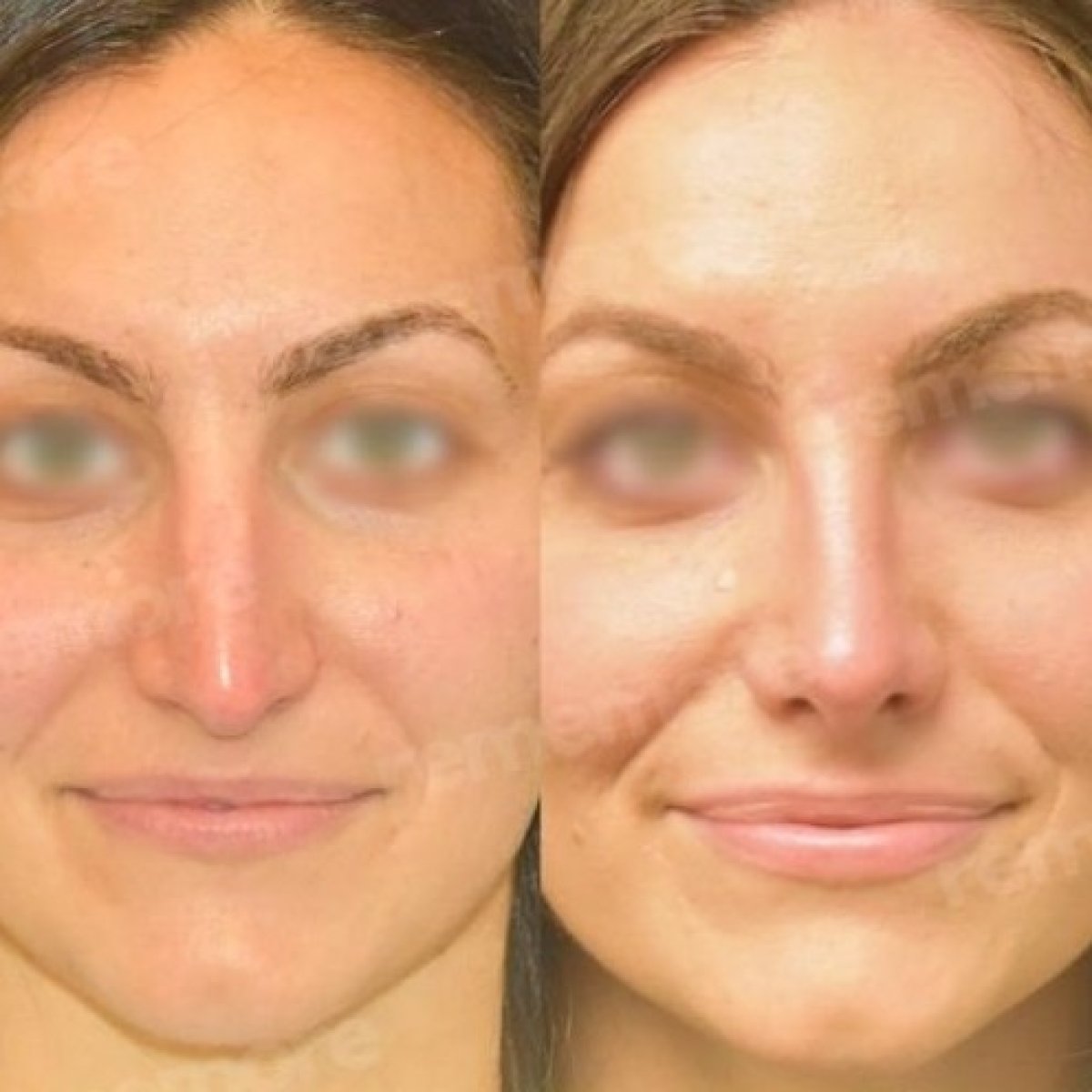 Resultados antes y después de rinoplastia étnica en Memorial Bahçelievler Hospital, remodelación nasal