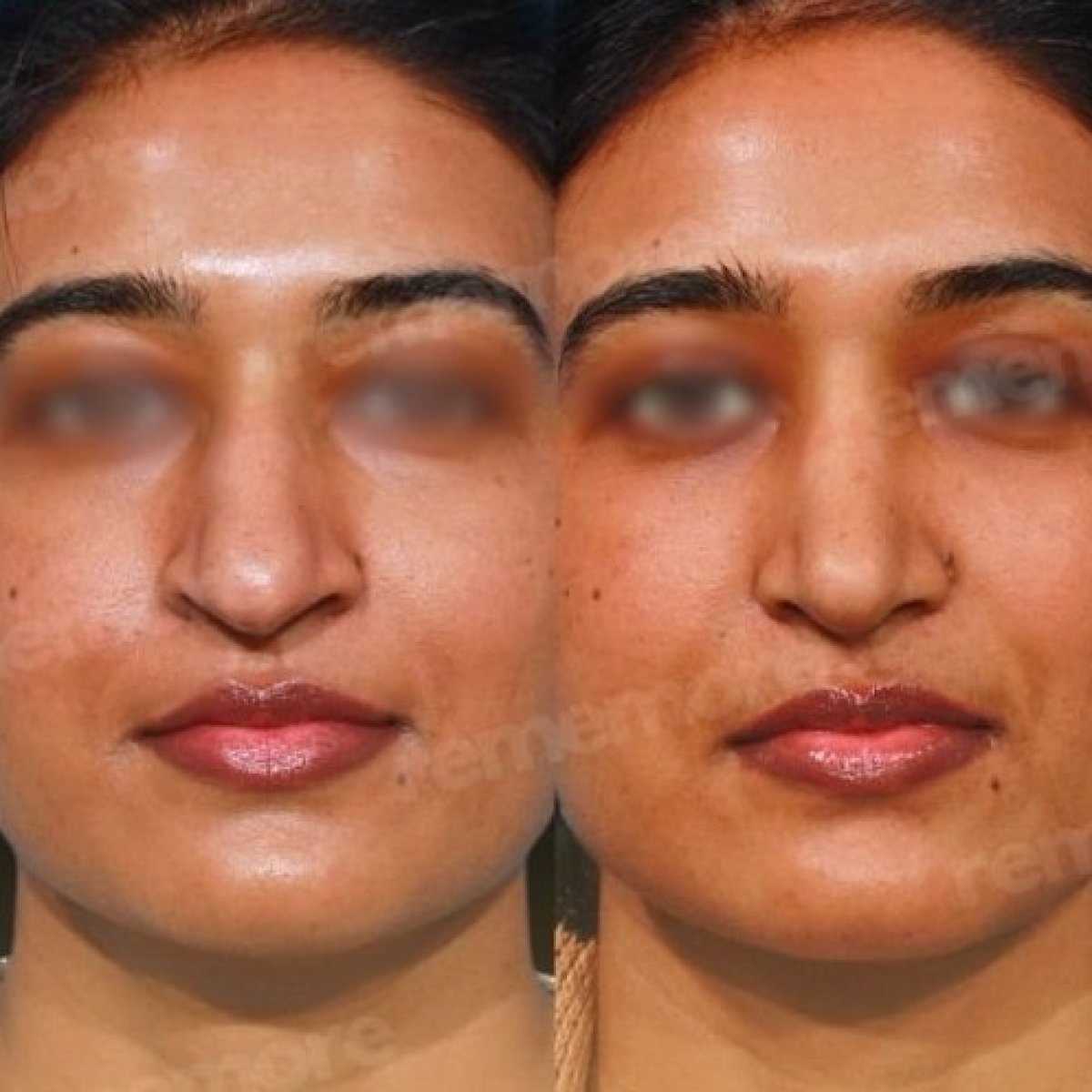 Resultados de rinoplastia étnica antes y después en Memorial Bahçelievler Hospital, remodelación nasal