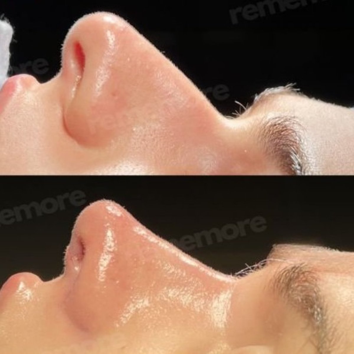 Resultado antes y después de rinoplastia étnica en Memorial Bahçelievler Hospital, remodelación nasal