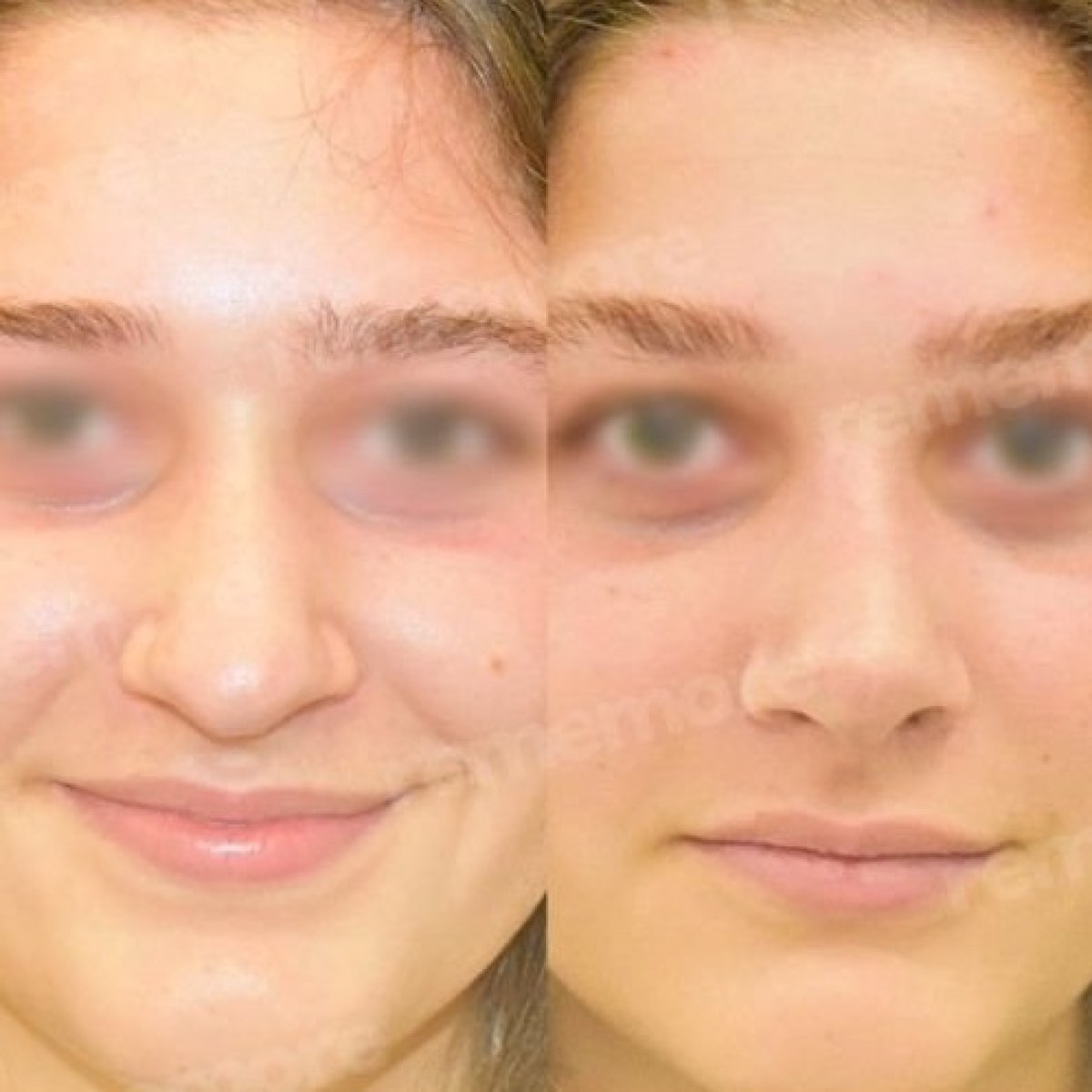 Resultados de rinoplastia étnica antes y después en Memorial Bahçelievler Hospital, remodelación nasal