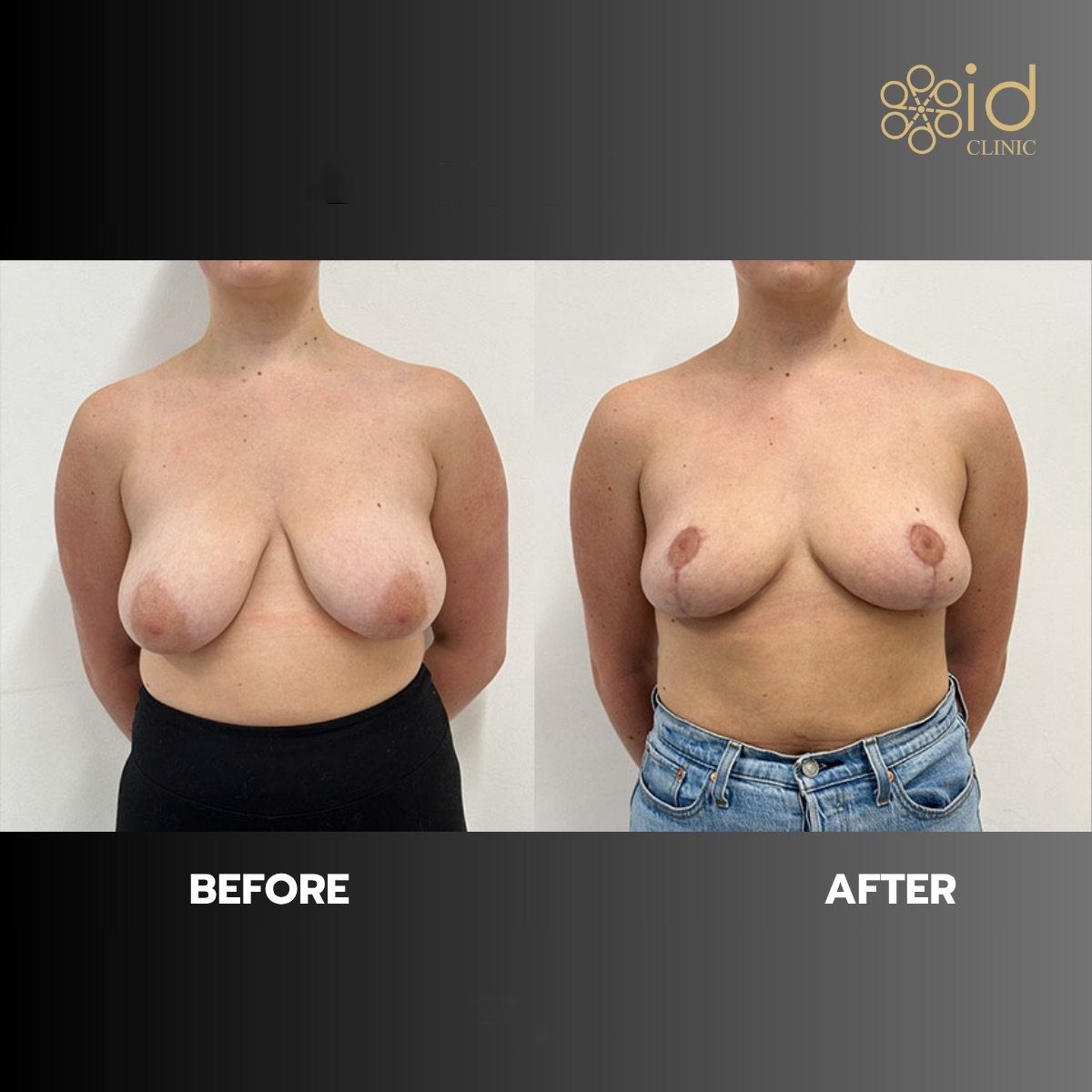 Avant-après implants mammaires avec lifting à ID Clinic Bangkok, forme améliorée