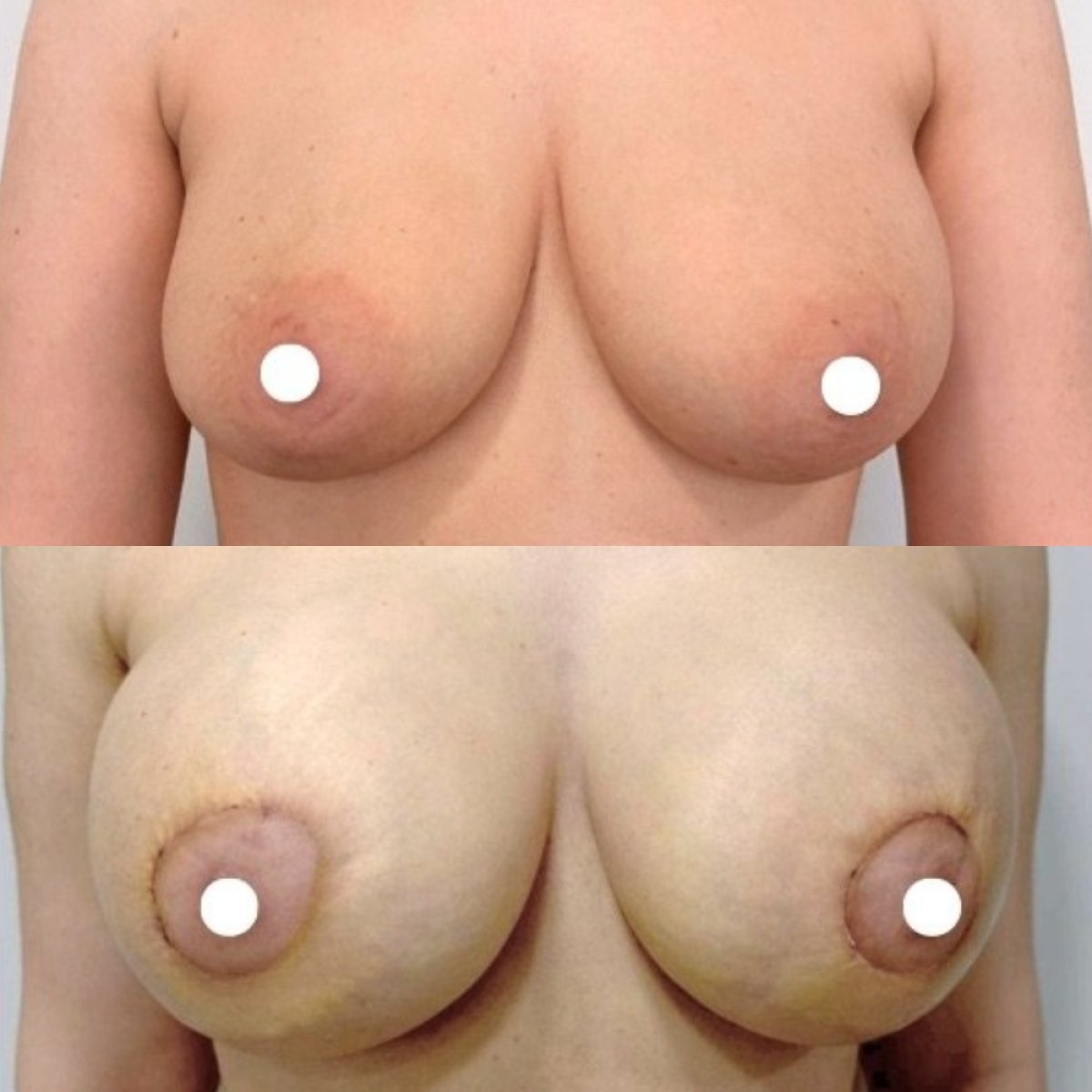 Before and after breast implants with lift results at ID Clinic Bangkok, enhanced breast shape
