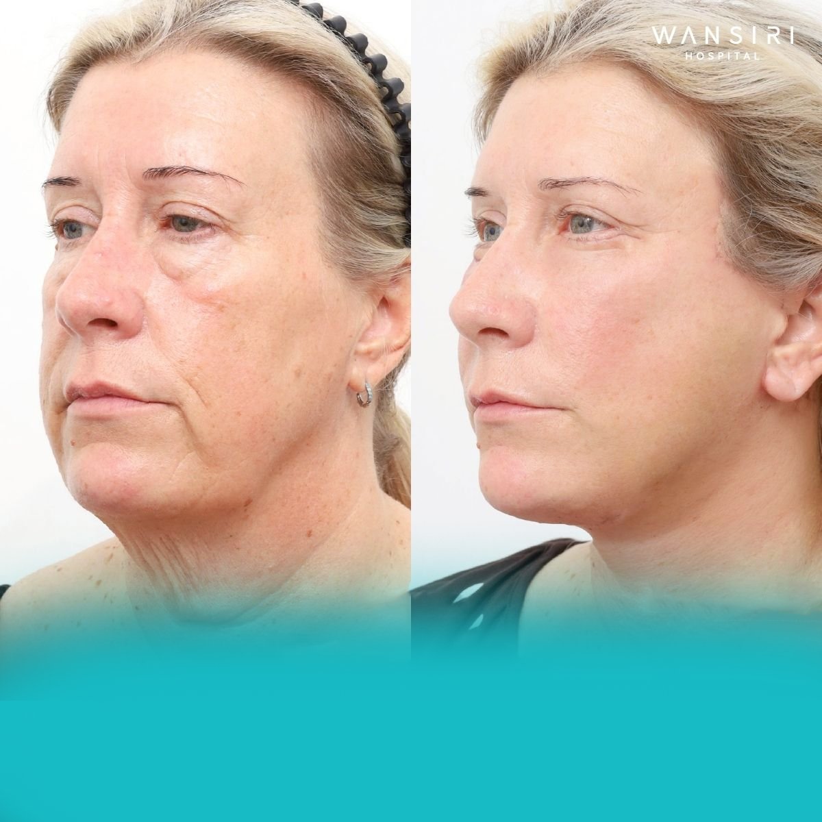 Avant et après injection de fillers à Wansiri Hospital, résultat rajeunissant visible