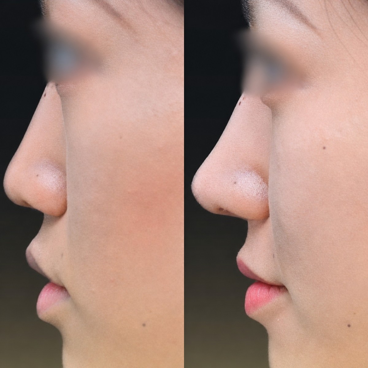 Before and after revision rhinoplasty results at Memorial Bahçelievler Hospital, nose reshaping