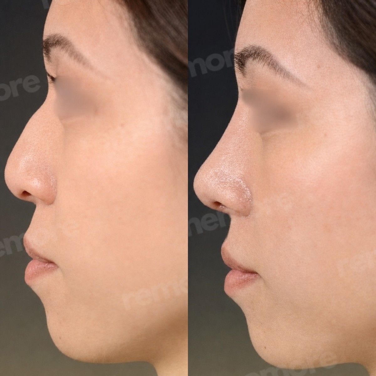 Before and after revision rhinoplasty result at Memorial Bahçelievler Hospital, improved nose shape