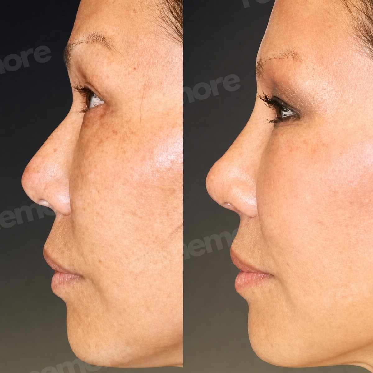 Resultados antes y después de rinoplastia de revisión en Memorial Bahçelievler Hospital, remodelación nasal