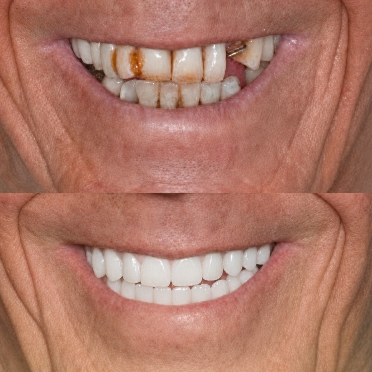 Resultados antes y después de implantes cigomáticos en Memorial Bahçelievler Hospital, restauración de sonrisa