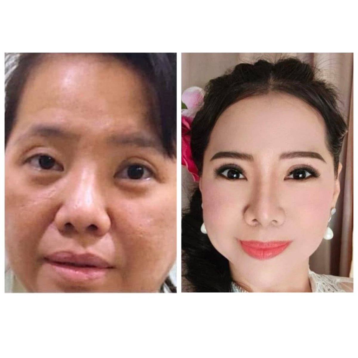 Before and after deep plane facelift results at Somchai Clinic, facial rejuvenation visible