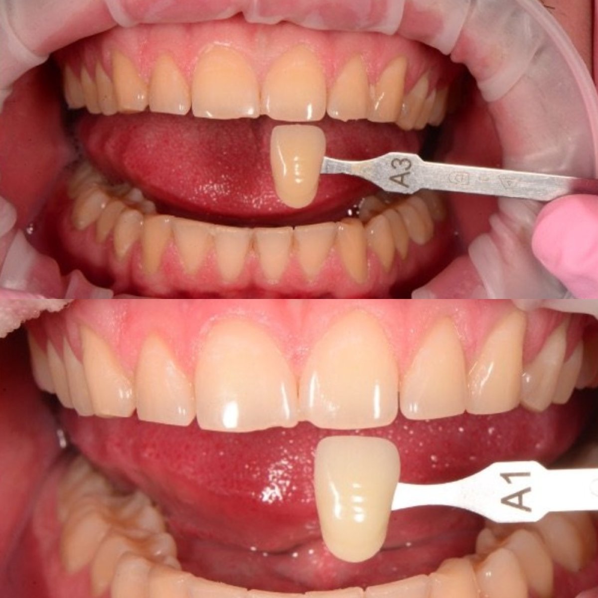 Resultados de blanqueamiento dental antes y después en RIKOTA Dental Clinic – sonrisa más blanca