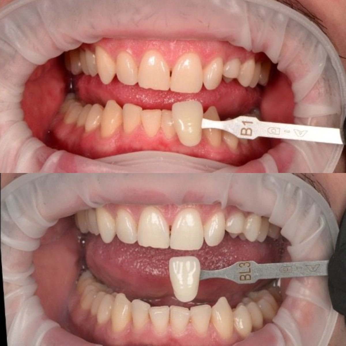 نتائج تبييض الأسنان قبل وبعد في RIKOTA Dental Clinic – ابتسامة أكثر بياضًا بوضوح