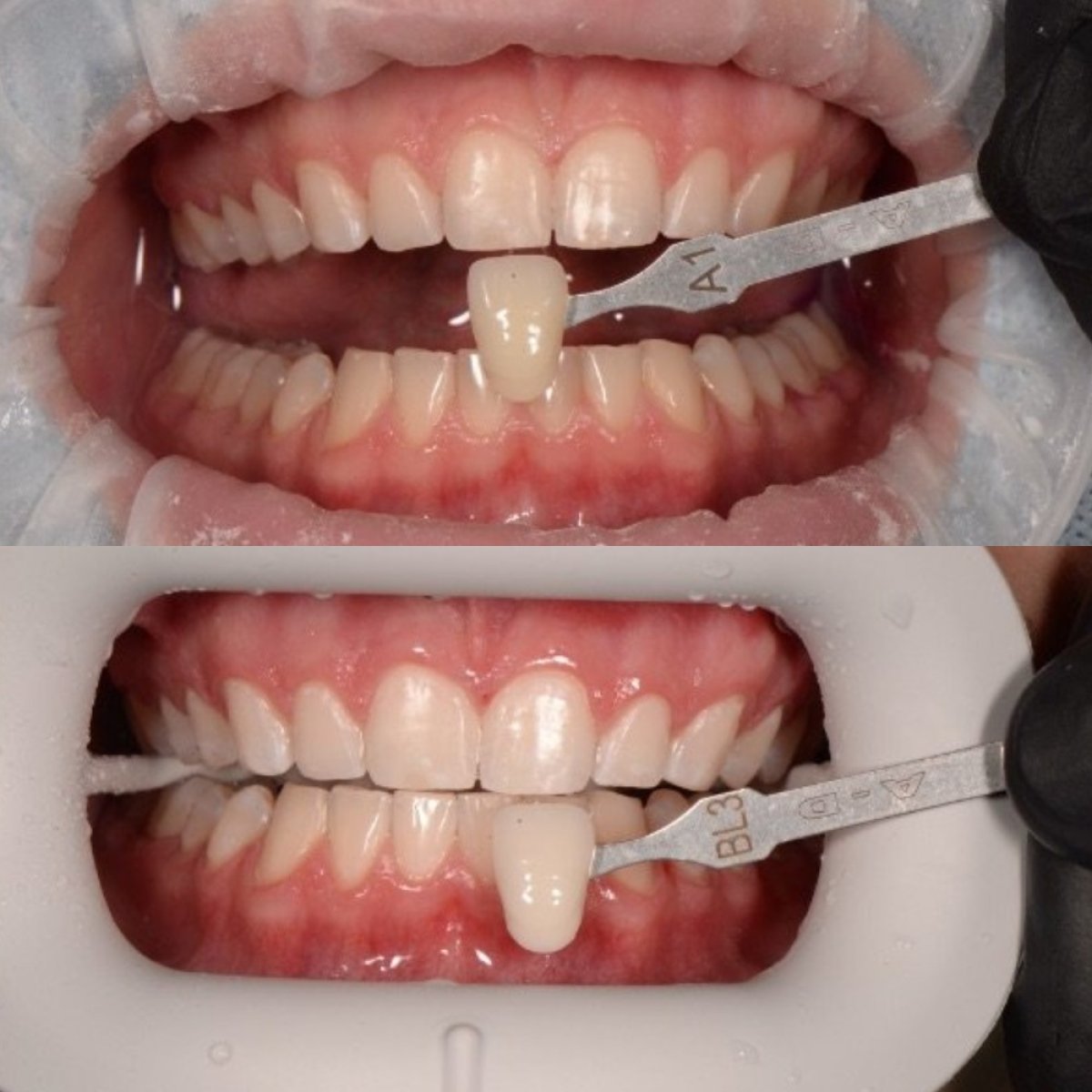نتائج تبييض الأسنان قبل وبعد في RIKOTA Dental Clinic – ابتسامة أكثر إشراقًا