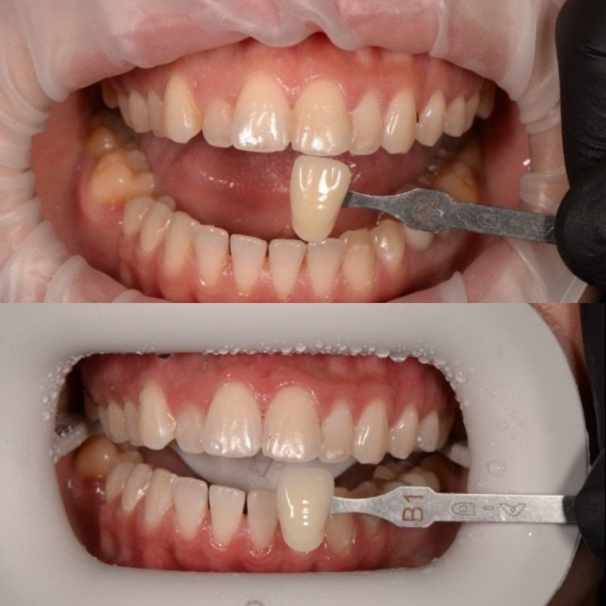 نتائج تبييض الأسنان قبل وبعد في RIKOTA Dental Clinic – ابتسامة أكثر بياضًا بوضوح