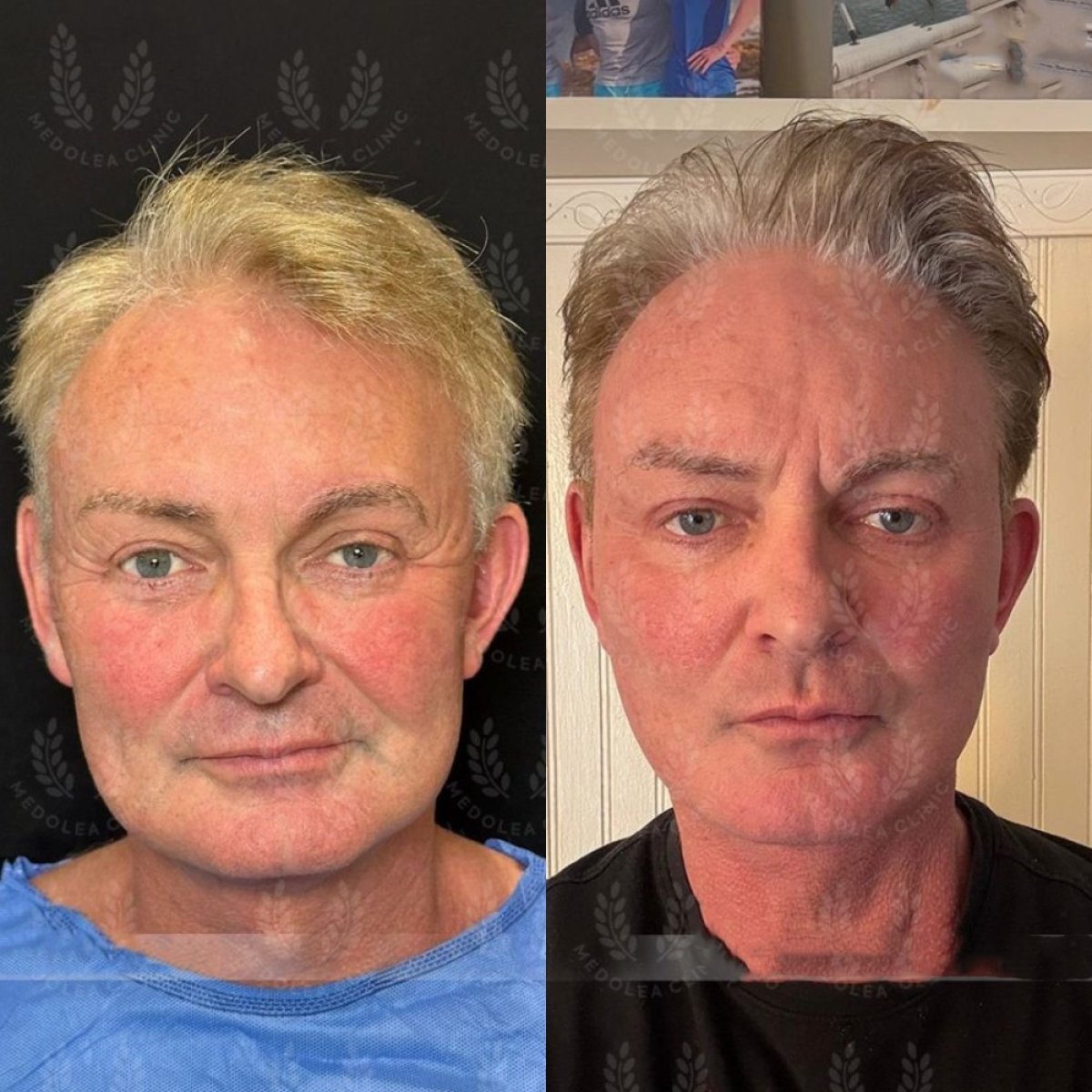 Resultados de lifting de frente antes y después en Dr. Safa Manav Clinic, frente más lisa