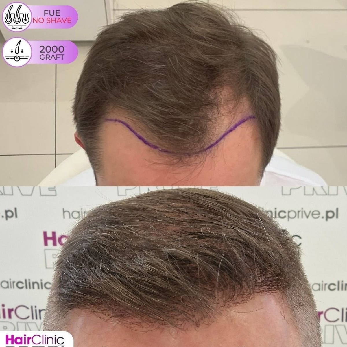 Before and after FUE no-shave hair transplant result, 2000 grafts at Hair Clinic PRIVÉ