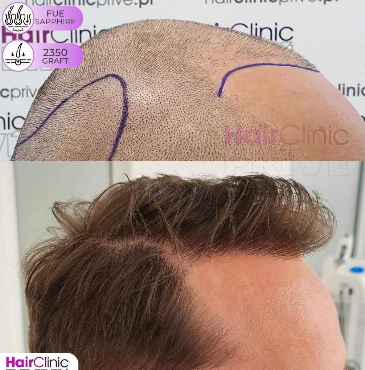 نتيجة زراعة الشعر FUE في Hair Clinic PRIVÉ، 2350 طعماً، خط شعر طبيعي