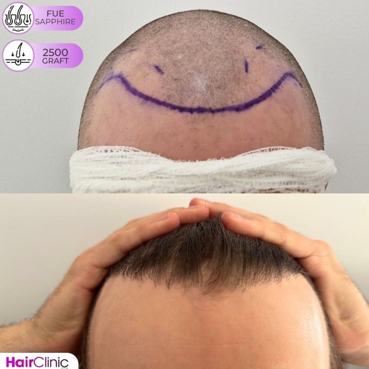 Before and after FUE hair transplant at Hair Clinic PRIVÉ, 2500 grafts for fuller hairline result