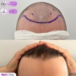 Hair transplant results by Dr. Mariia Zaplava - Patient’s before and after images Before and after Hair transplant photos by Dr. Mariia Zaplava