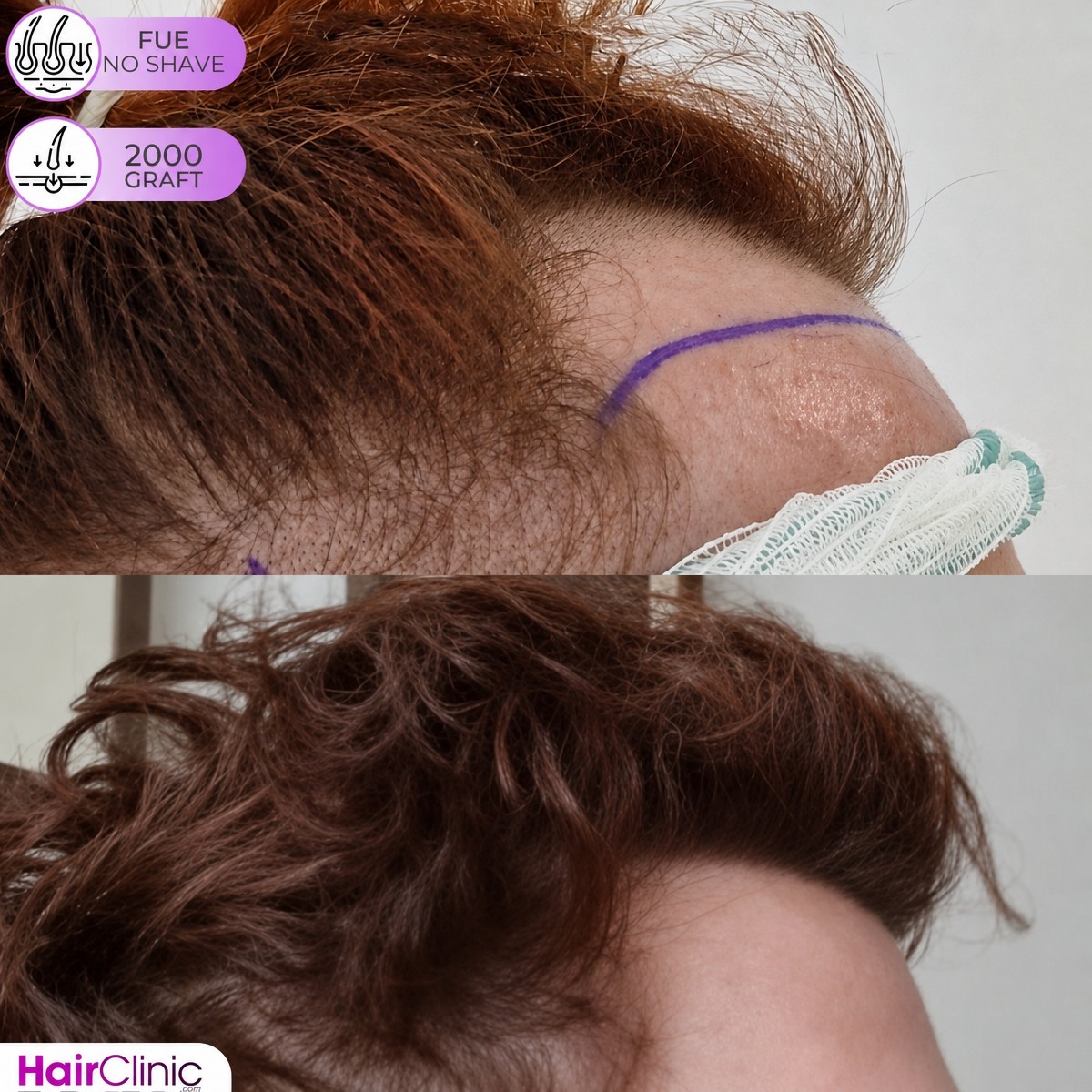 Vorher-nachher-Ergebnis FUE-Haartransplantation ohne Rasur bei Hair Clinic PRIVÉ, 2000 Grafts