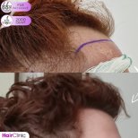 Hair transplant results by Dr. Mariia Zaplava - Patient’s before and after images Before and after Hair transplant photos by Dr. Mariia Zaplava