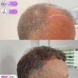 Hair transplant results by Dr. Mariia Zaplava - Patient’s before and after images Before and after Hair transplant photos by Dr. Mariia Zaplava