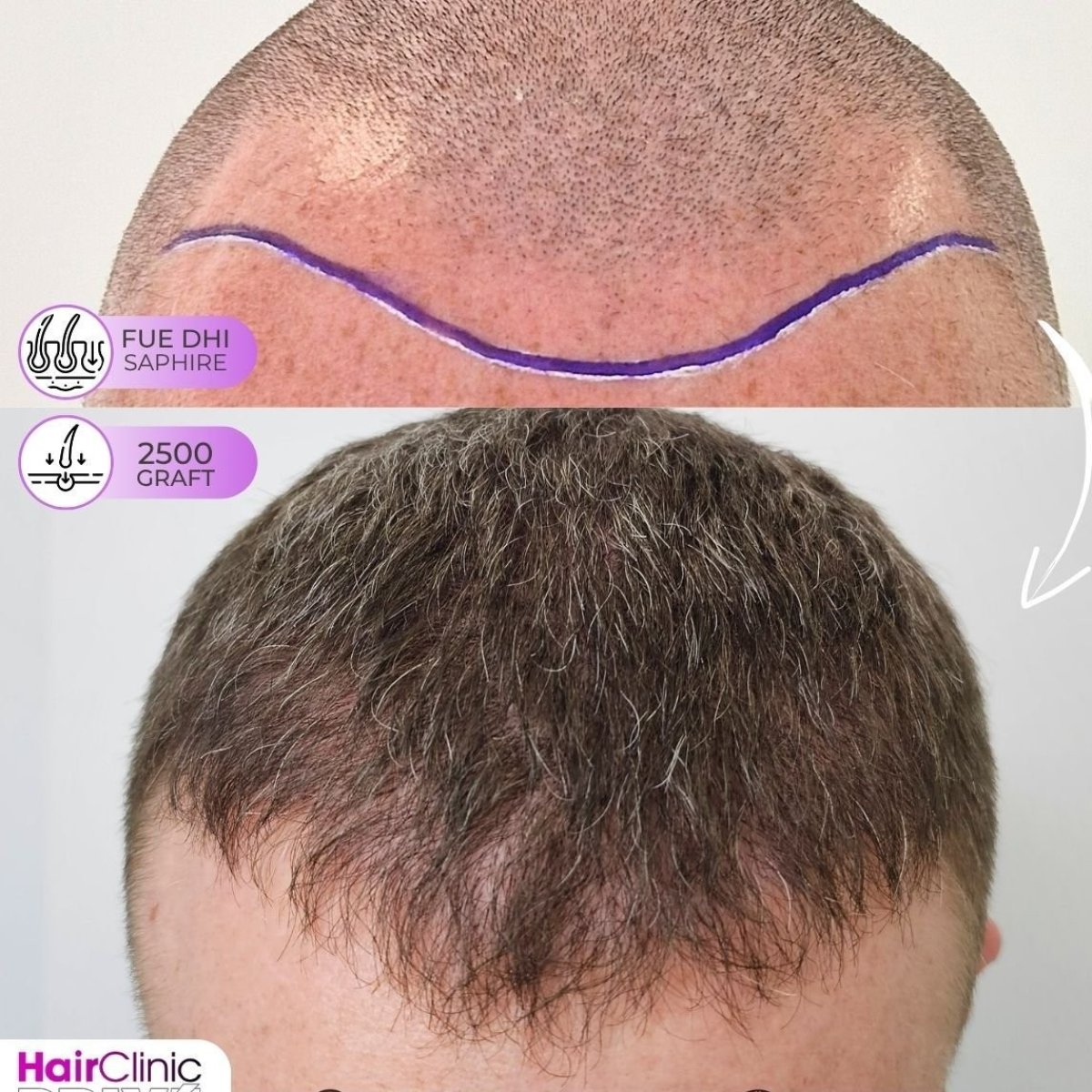 Before and after FUE hair transplant at Hair Clinic PRIVÉ, 2500 grafts natural result