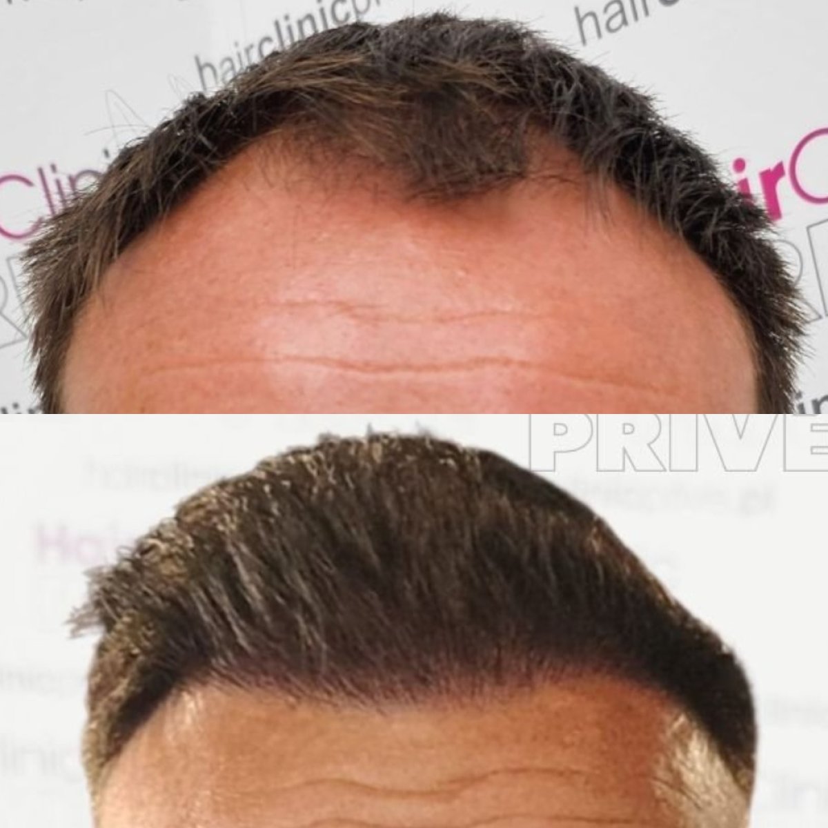 Resultado antes y después de trasplante capilar DHI en Hair Clinic PRIVÉ, línea restaurada