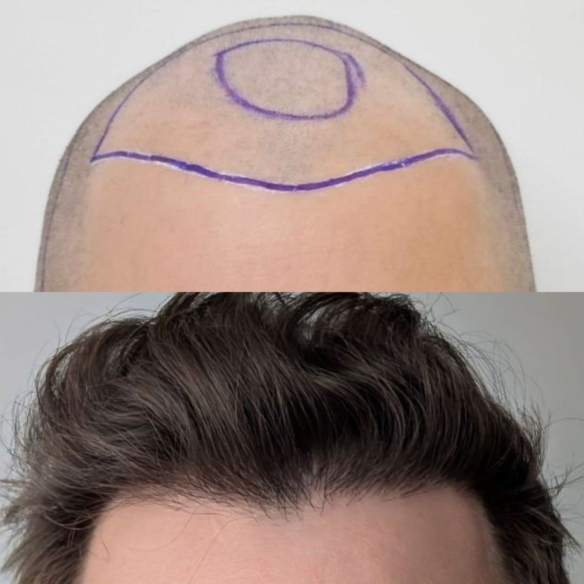 Результат до и после пересадки волос DHI в Hair Clinic PRIVÉ, восстановленная линия роста