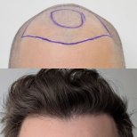Hair transplant results by Dr. Mariia Zaplava - Patient’s before and after images Before and after Hair transplant photos by Dr. Mariia Zaplava