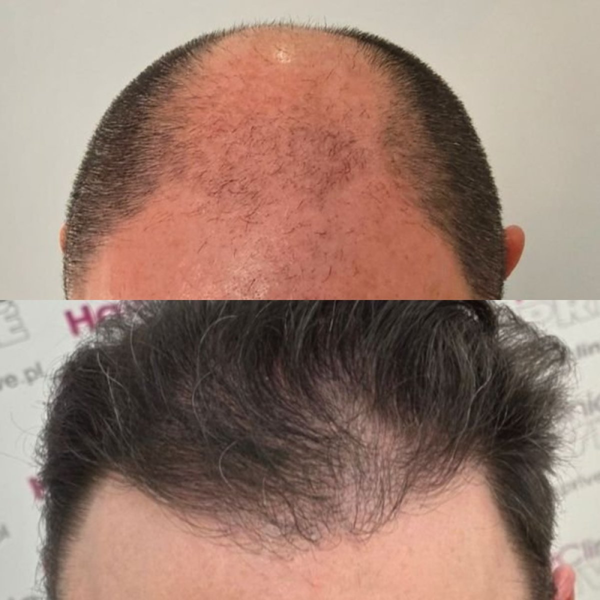 Результат до и после DHI пересадки волос в Hair Clinic PRIVÉ – восстановленная линия волос