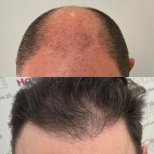 Hair transplant results by Dr. Mariia Zaplava - Patient’s before and after images Before and after Hair transplant photos by Dr. Mariia Zaplava