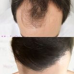 Hair transplant results by Dr. Mariia Zaplava - Patient’s before and after images Before and after Hair transplant photos by Dr. Mariia Zaplava