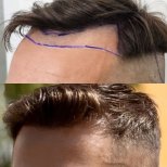 Hair transplant results by Dr. Mariia Zaplava - Patient’s before and after images Before and after Hair transplant photos by Dr. Mariia Zaplava