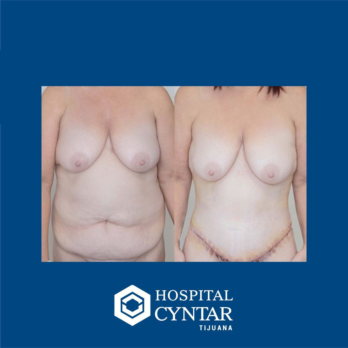 نتائج شد البطن قبل وبعد في HOSPITAL CYNTAR TIJUANA – تحسين شكل البطن