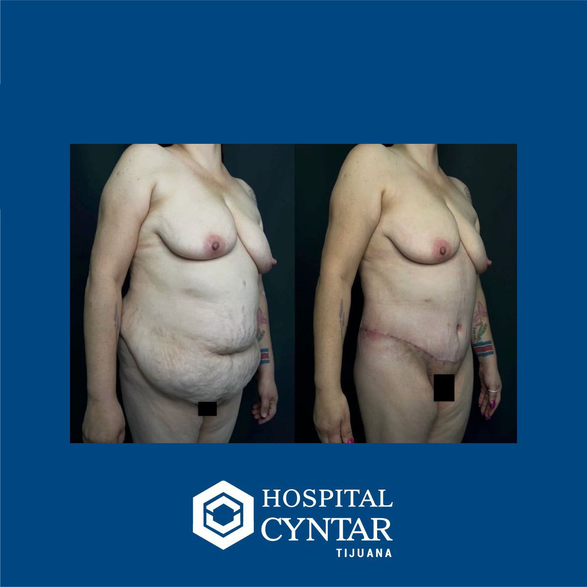 نتائج شد البطن قبل وبعد في HOSPITAL CYNTAR TIJUANA، تحسين شكل البطن