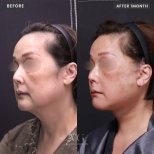 Fotos vor und nach Fettabsaugung durch Dr. Park Sangwook 