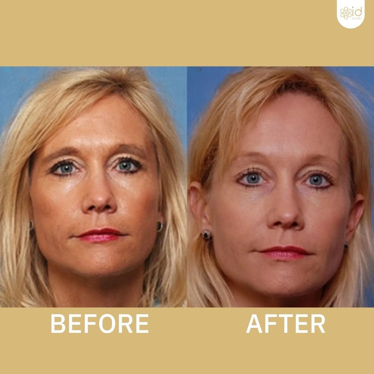 Before and after lower eyelid blepharoplasty results at ID Clinic Bangkok, rejuvenated eyes