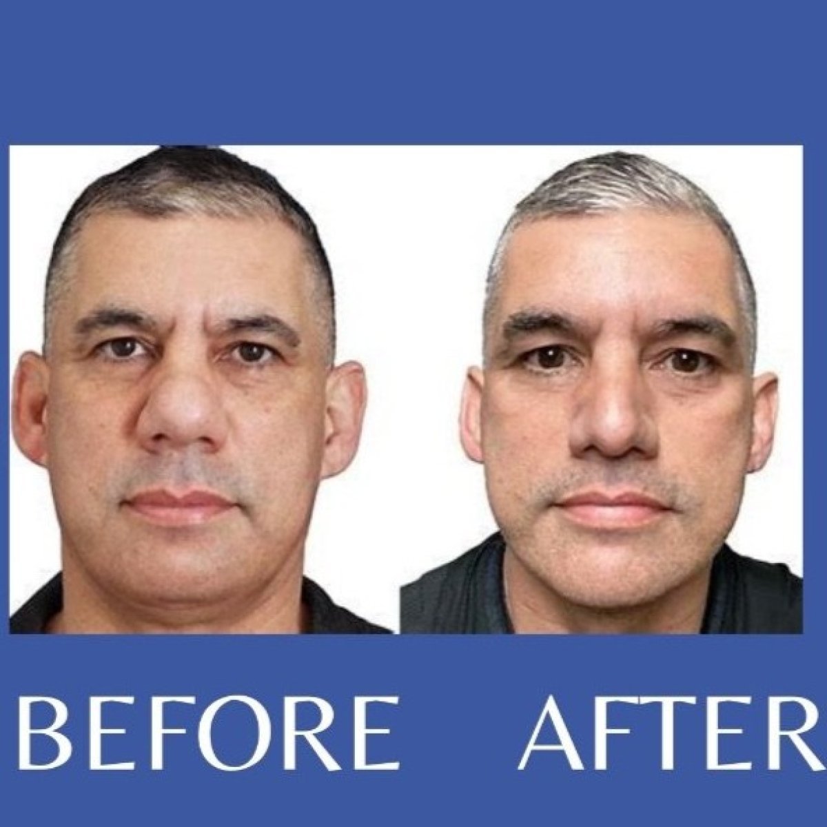 Before and after ethnic rhinoplasty results at ID Clinic Bangkok, improved nose shape