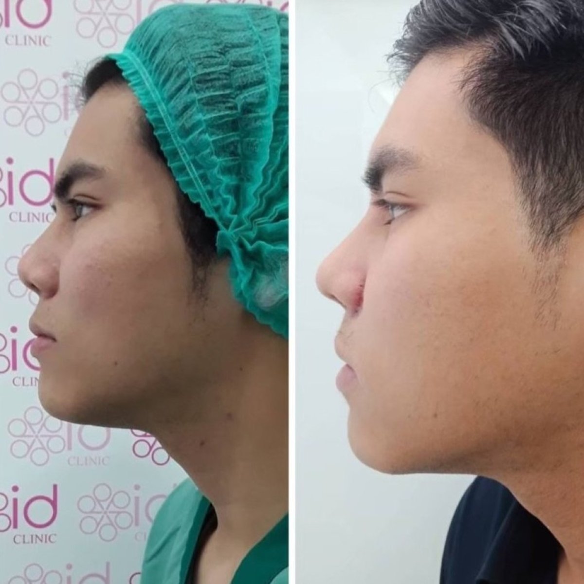 Before and after ethnic rhinoplasty results at ID Clinic Bangkok, improved nose profile