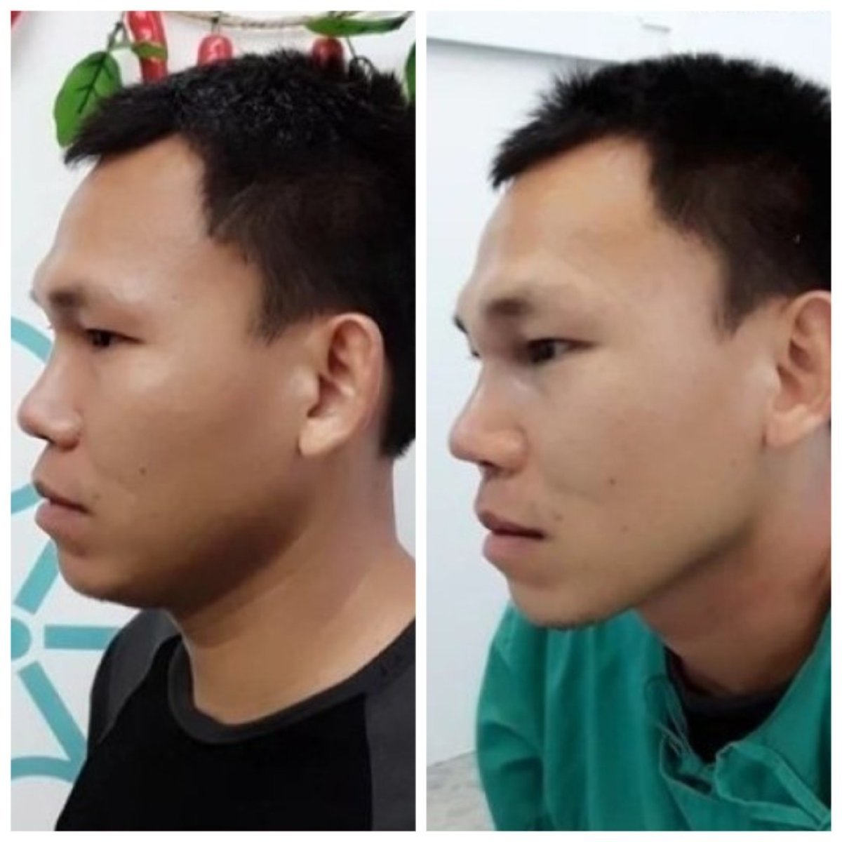 Before and after ethnic rhinoplasty result at ID Clinic Bangkok, improved nose profile